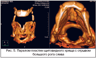 Рис. 5. Перелом пластин щитовидного хряща с отрывом большого рога слева