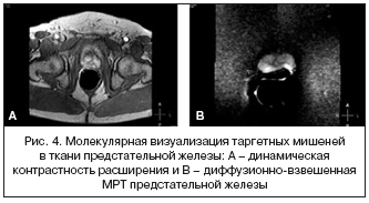 Рис. 4. Молекулярная визуализация таргетных мишеней в ткани предстательной железы: А – динамическая контрастность расширения и В – диффузионно-взвешенная МРТ предстательной железы