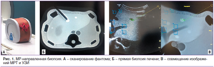 Рис. 1. МР-направленная биопсия. А – сканирование фантома; Б – прямая биопсия печени; В – совмещение изображений МРТ и УЗИ
