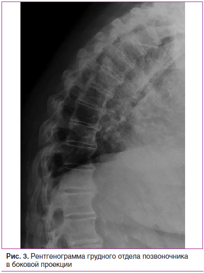 Рис. 3. Рентгенограмма грудного отдела позвоночника в боковой проекции
