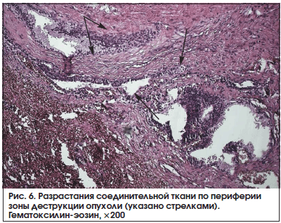 Рис. 6. Разрастания соединительной ткани по периферии зоны деструкции опухоли (указано стрелками). Гематоксилин-эозин, ×200