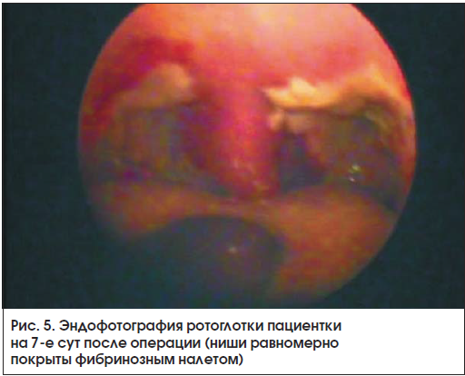 Рис. 5. Эндофотография ротоглотки пациентки на 7-е сут после операции (ниши равномерно покрыты фибринозным налетом)