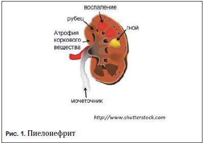 Пиелонефрит (воспаление почек)