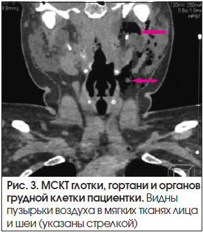 Рис. 3. МСКТ глотки, гортани и органов грудной клетки пациентки. Видны пузырьки воздуха в мягких тканях лица и шеи (указаны стрелкой)