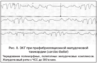 Рис. 8. ЭКГ при префибрилляционной желудочковой тахикардии (cardiac ballet)
