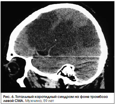 Ишемический инсульт левой средней мозговой артерии thumbnail
