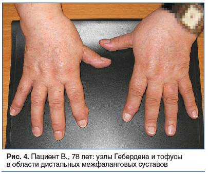 Рис. 4. Пациент В., 78 лет: узлы Гебердена и тофусы в области дистальных межфаланговых суставов