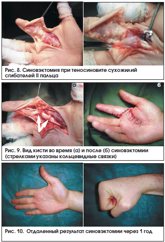 Как диагностировать тендинит запястья руки - советы ортопеда