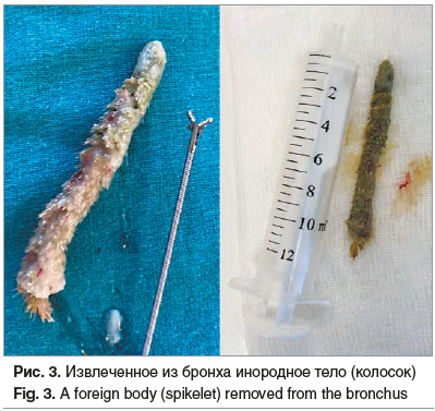 Рис. 3. Извлеченное из бронха инородное тело (колосок) Fig. 3. A foreign body (spikelet) removed from the bronchus