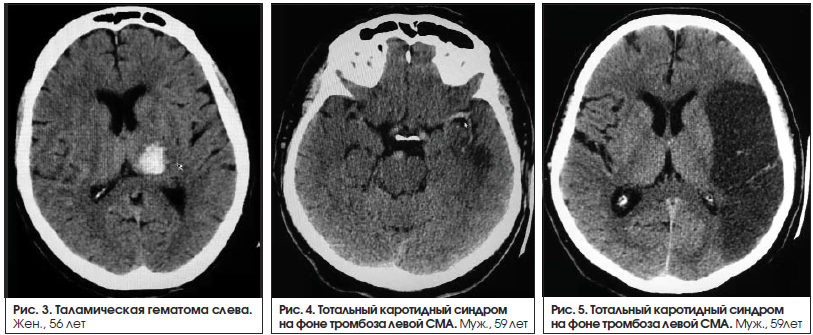 Клиника инсульта в левой средней мозговой артерии thumbnail