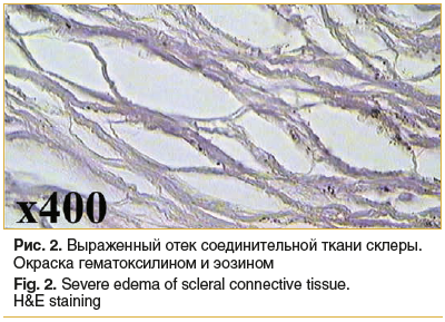 Рис. 2. Выраженный отек соединительной ткани склеры. Окраска гематоксилином и эозином Fig. 2. Severe edema of scleral connective tissue. H&E staining